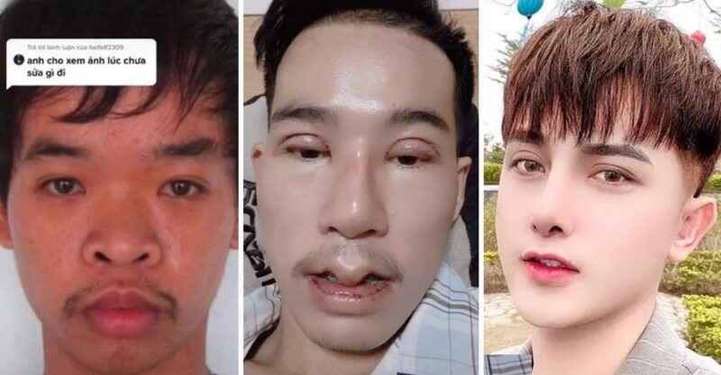 Jovem faz 9 cirurgias faciais para encontrar um emprego, o rejeitaram porque consideravam seu rosto “feio”